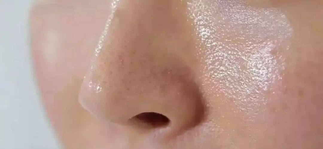 鸡皮肤黑头毛孔(鸡皮肤黑头毛孔会变大吗) 鸡皮肤黑头毛孔(鸡皮肤黑头毛孔会变大吗)