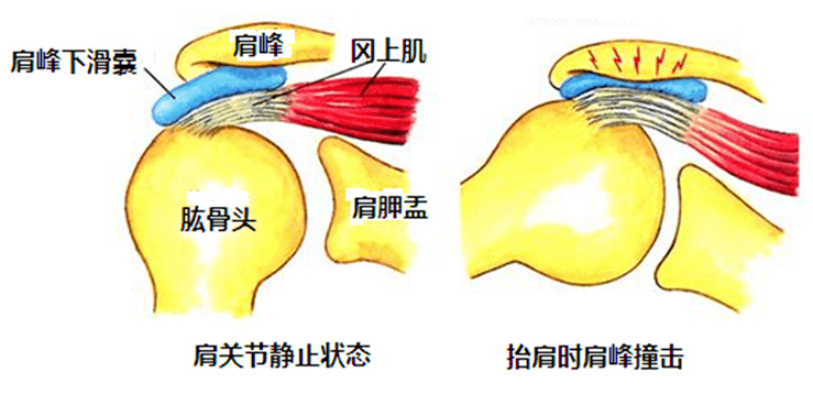 肩峰下撞击综合征