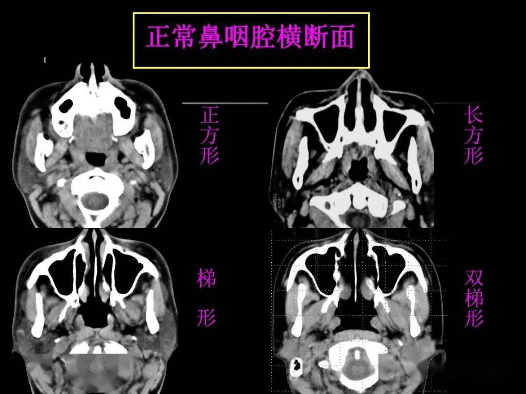 鼻咽部ct解剖