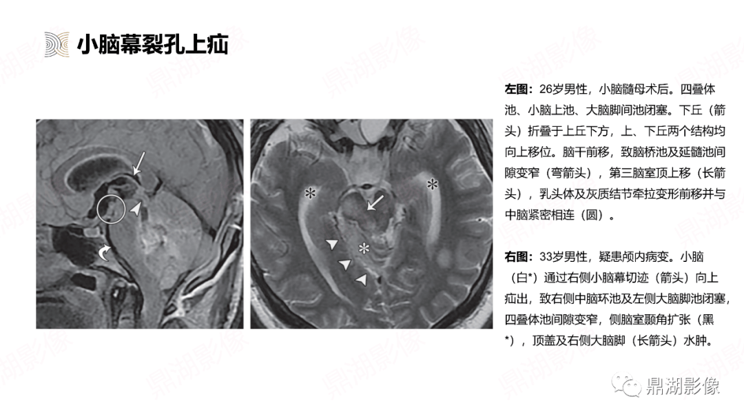 圖解腦疝分類及影像學特_患者