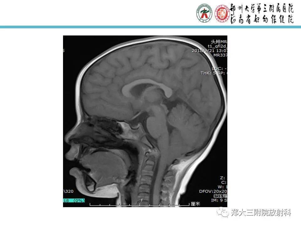 小腦扁桃體下疝畸形(chiari畸形)_平臺