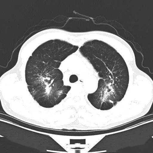 二期矽肺ct图片特征图片