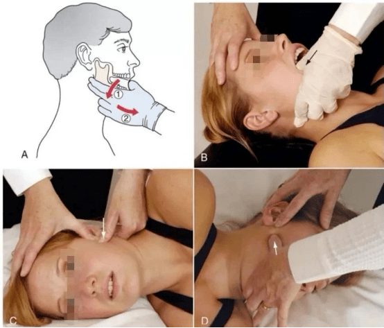 (2)颞下颌关节前脱位口内复位术(3)颞下颌关节紊乱患者常见有咬肌等