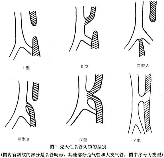 此病产前诊断困难,多因生后有口腔分泌物过多,喂养后呛咳,青紫,胃管