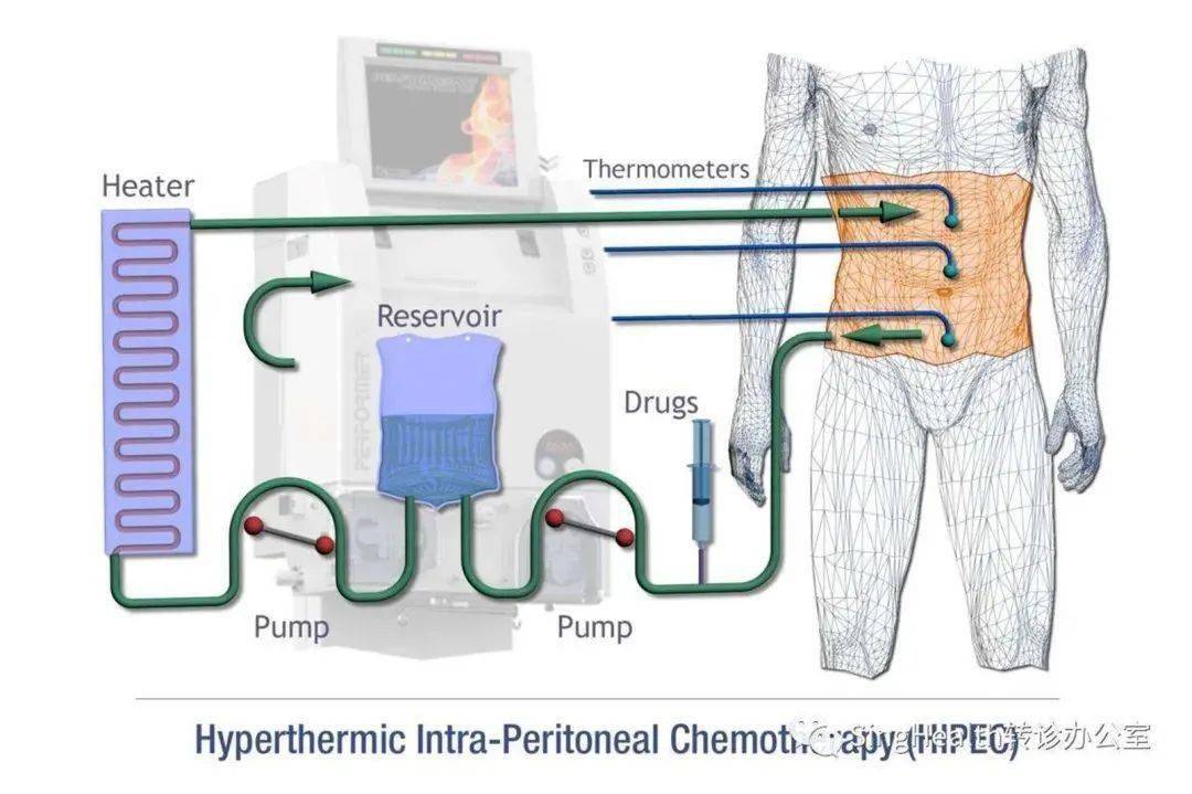 浅谈腹腔热灌注化疗