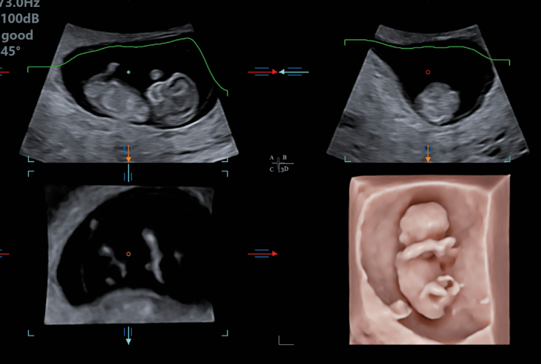 运用3d4d成像技术,实现全方位多角度观察胎儿;自动测量胎儿颈项透明层