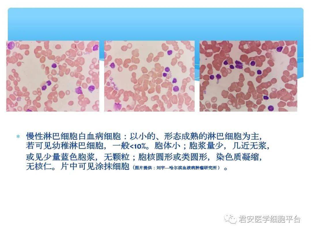 良恶性淋巴细胞形态特点汇总