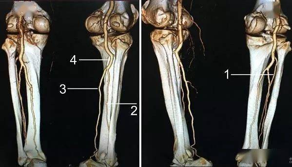 下肢血管解剖及cta檢查