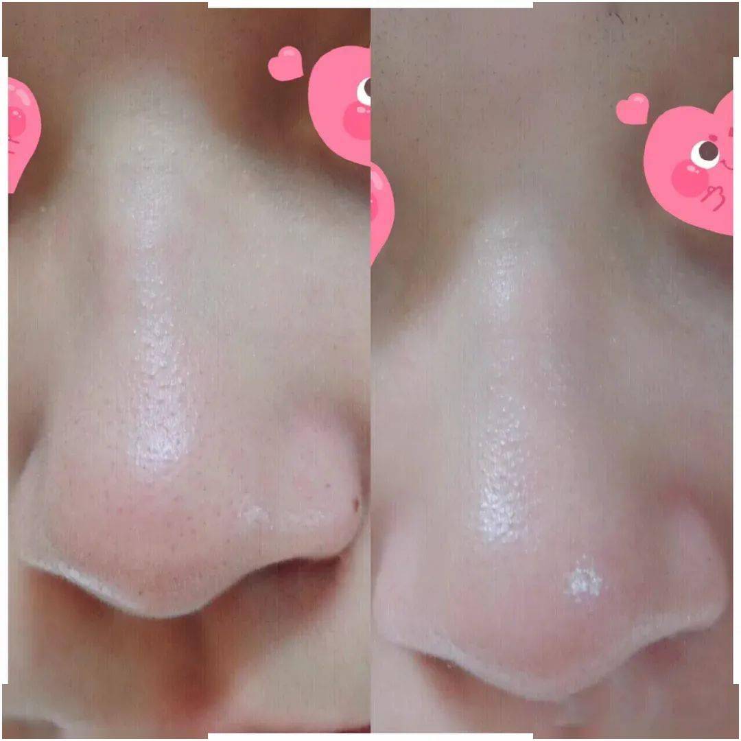 万年草莓鼻有救了!每天不到1块钱,米粒大的黑头连根拔起,又爽又恶心!