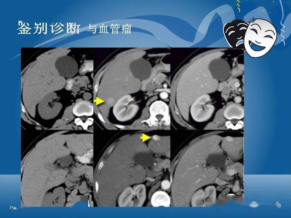 原發性肝細胞癌的ct和mri診斷