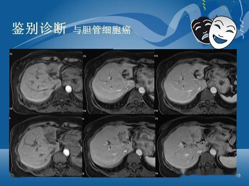 原發性肝細胞癌的ct和mri診斷