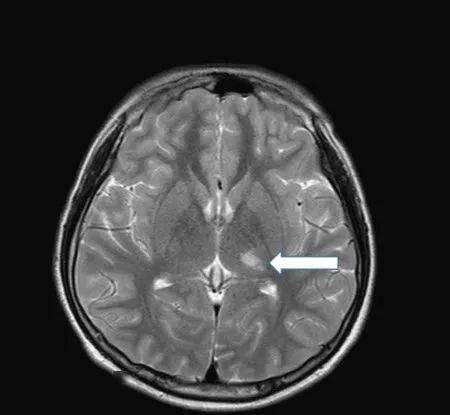 磁共振造影检查,显示左侧丘脑缺血梗塞(箭头处)这名少年在发病前几乎