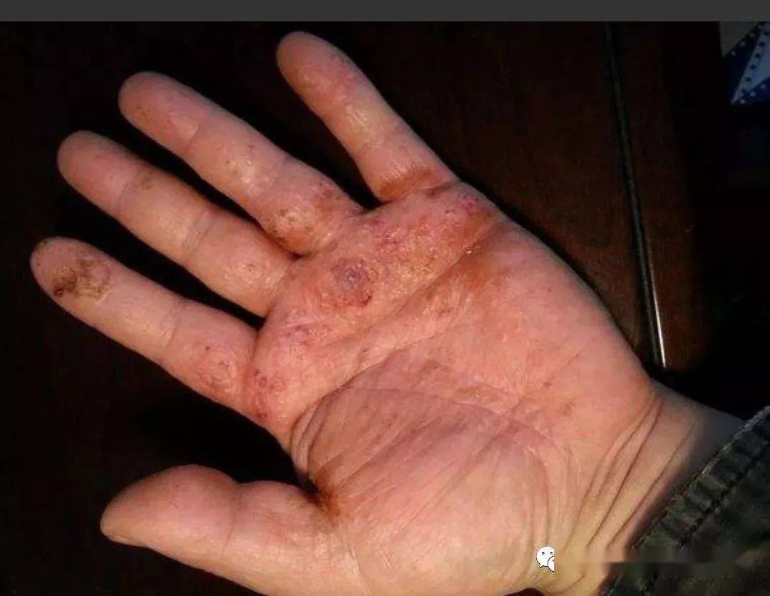 双手脱皮水泡瘙痒怎么办