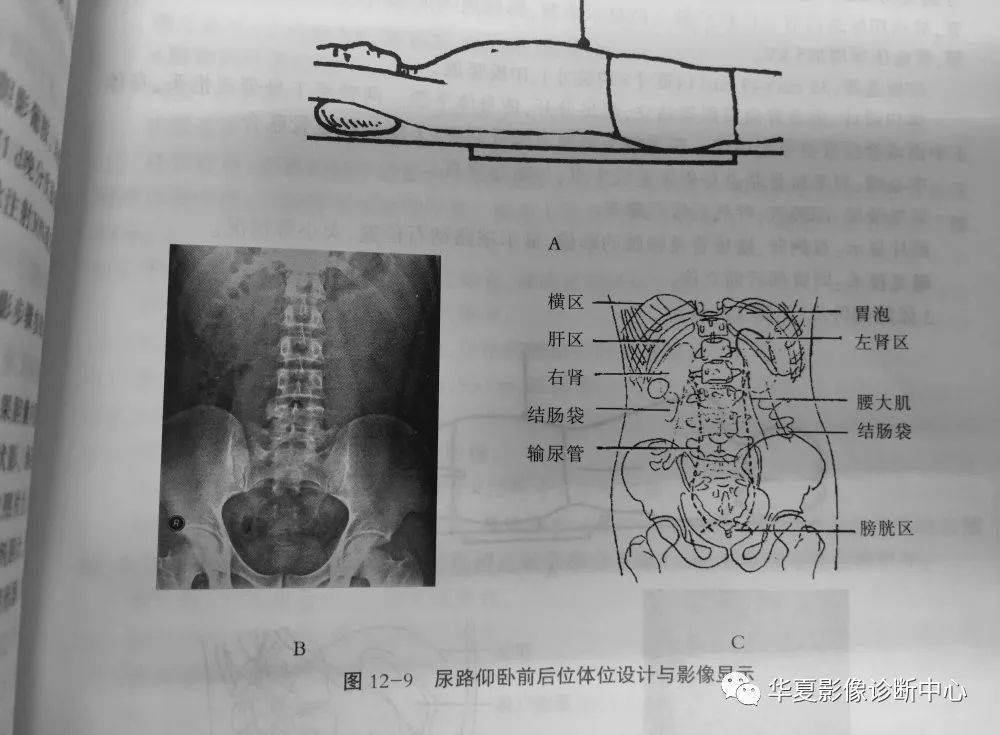 泌尿系统的拍片体位设计,腹部平片,你……了解几种._手机搜狐网