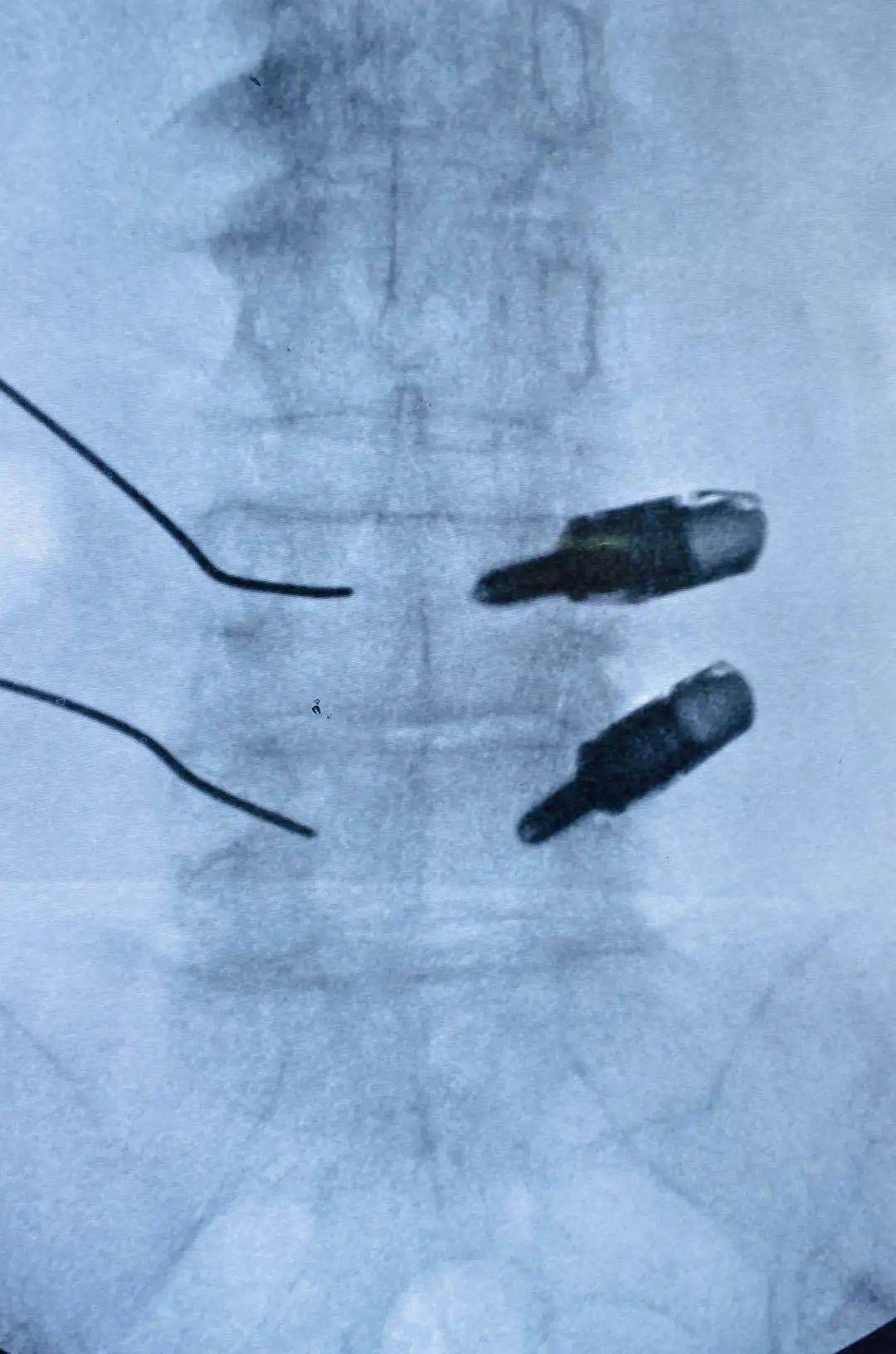 钛合金椎间融合器植入经皮置钉内固定治疗腰椎滑脱并椎管狭窄症_手术