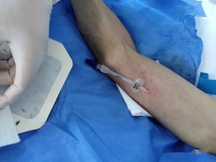 涉县中医院完成首例中等长度导管置入术_手机搜狐网