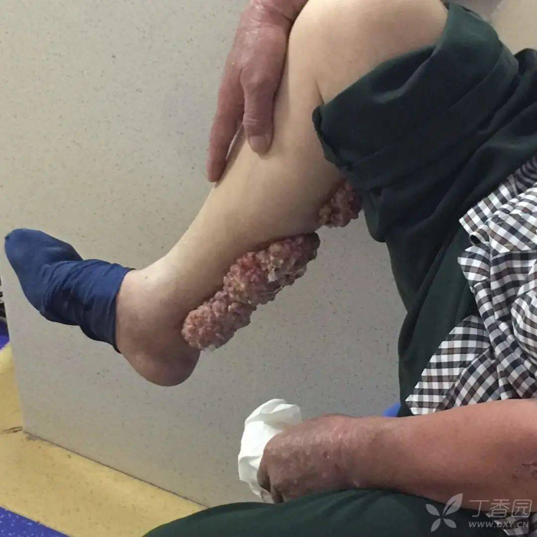 腿上出现肉泥样肿物疼痛腐臭味到底什么病
