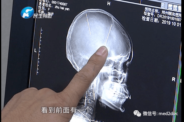 細思極恐一場車禍後意外發現29歲女子腦袋裡2根