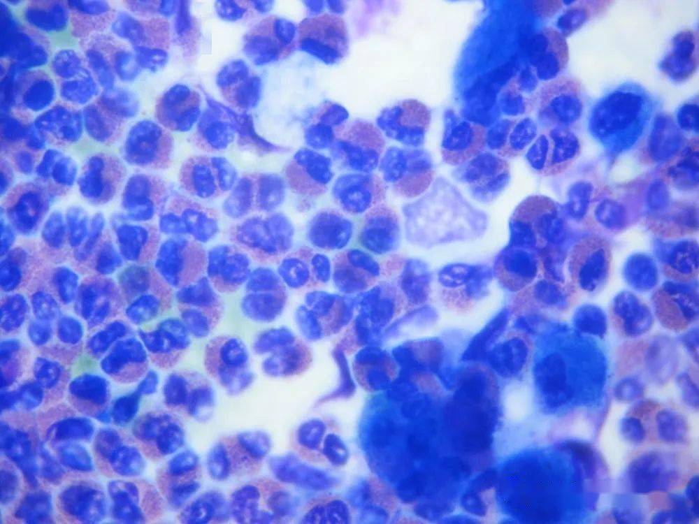 嗜酸性粒细胞红蓝图图片