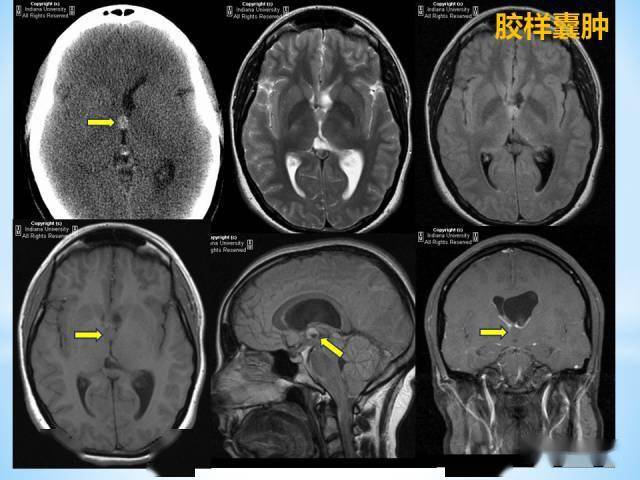 三脑室病变的mri表现