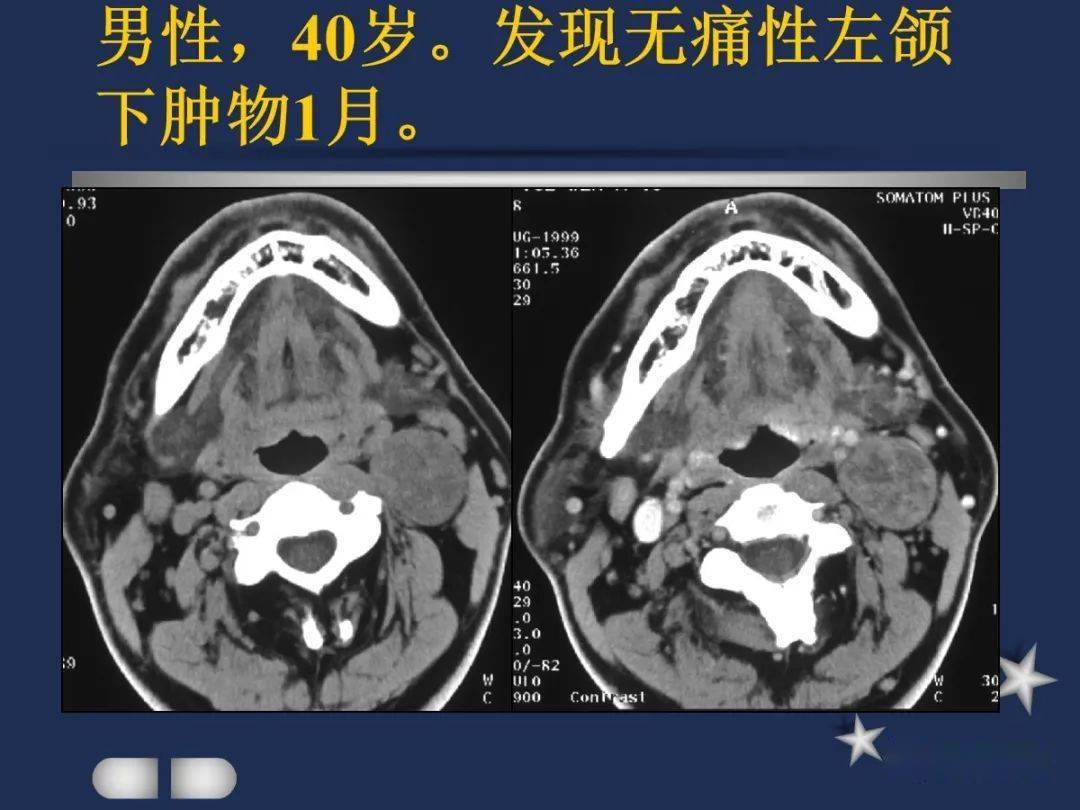 腮腺頸部疾病影像診斷