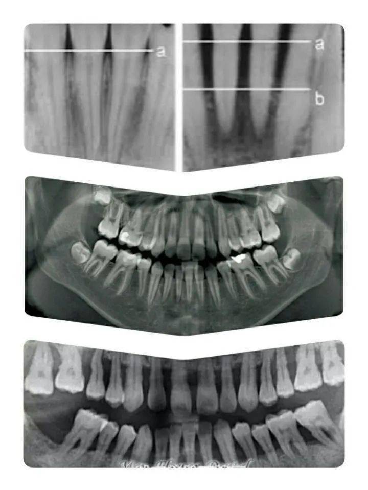 牙龈骨质增生怎么办图片