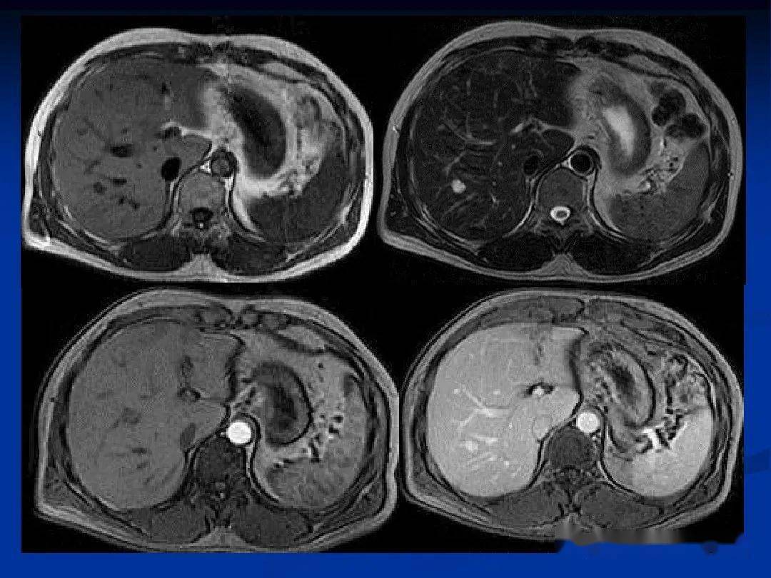 肝癌的磁共振影像图片图片