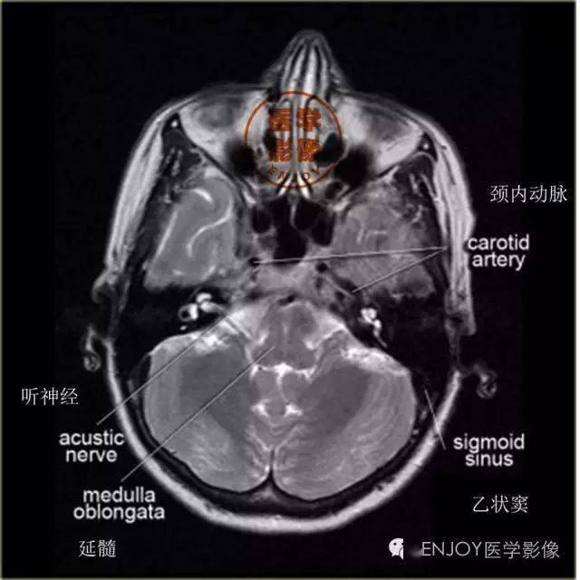 解剖颅脑丨高清头颅MRI断层解剖图谱-搜狐大视野-搜狐新闻