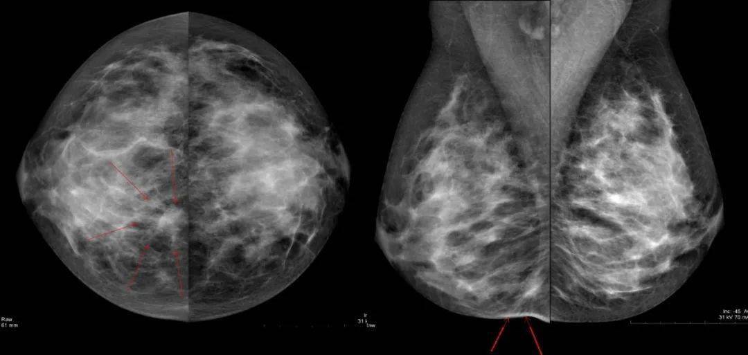 乳腺癌ct片图片图片