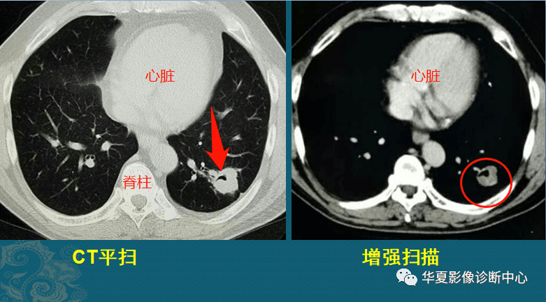 肺结核与肺癌ct片怎么区分医生教你4个读片小窍门