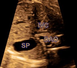 胎儿超声心动图基本切面与测量你想知道的这里都有