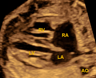 胎儿动脉导管切面图片图片