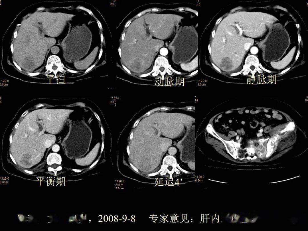 肝内周围型胆管细胞癌的影像特征
