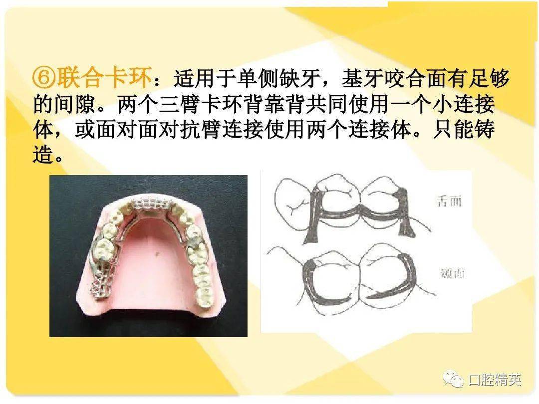 可摘局部义齿结构