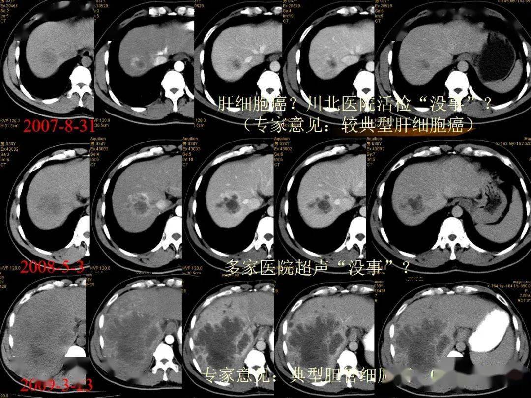 肝内周围型胆管细胞癌的影像特征