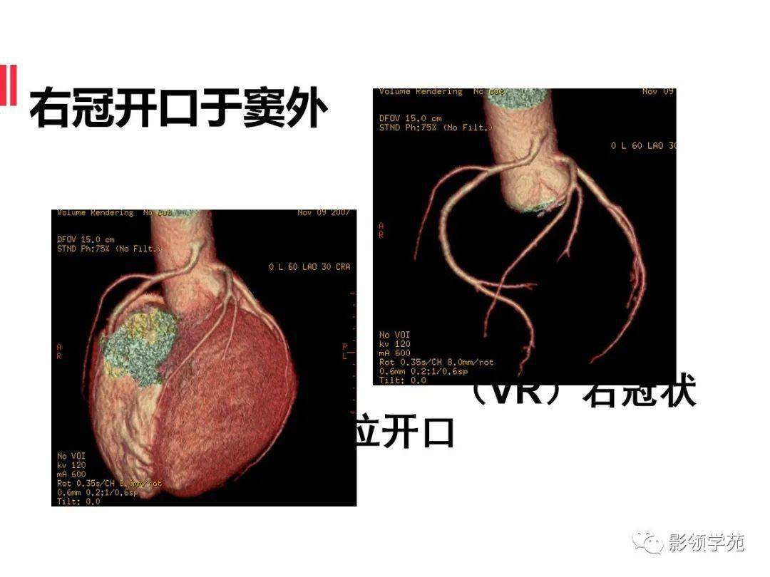 如何分析冠狀動脈cta