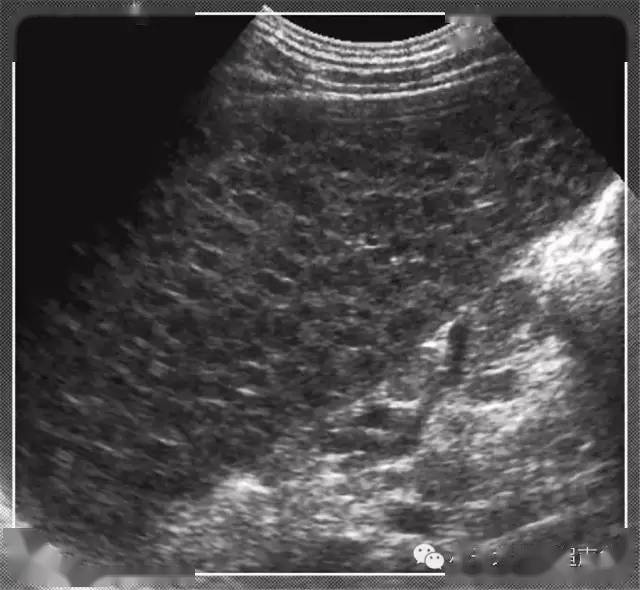 超声随响第13期脾脏淋巴瘤spleenlymphoma