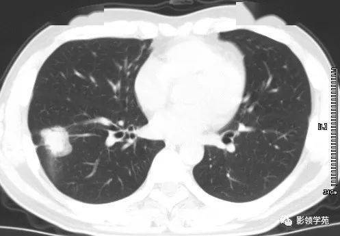 周围型肺癌
