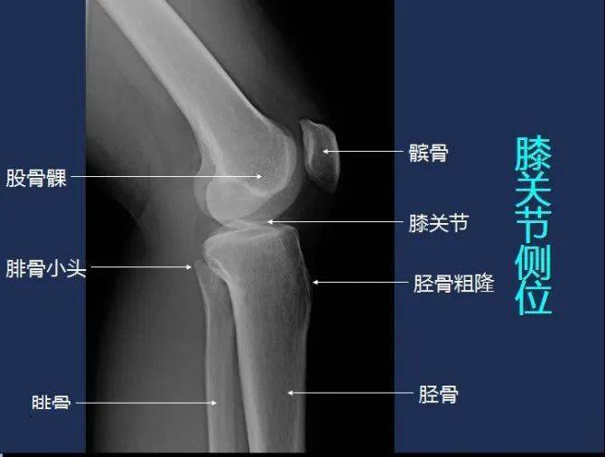 胫骨X线侧位片解剖图图片