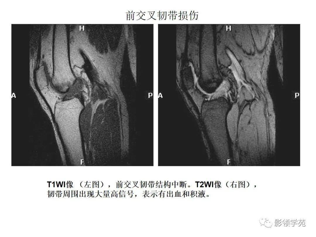 交叉韌帶解剖及損傷的mri診斷_膝關節