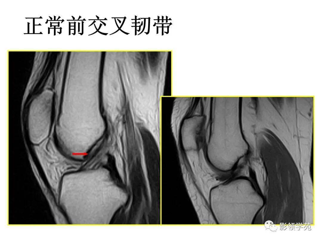 後交叉韌帶損傷正常後交叉韌帶mri表現後交叉韌帶自脛骨後緣關節面下