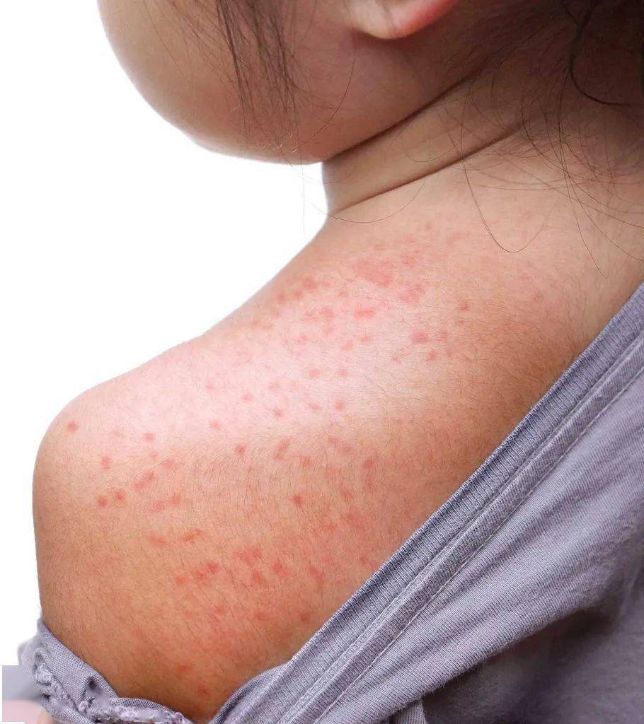 皮疹——或成为第四个常见新冠患病症状
