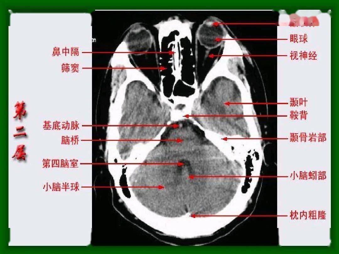 头颅CT解剖结构图片