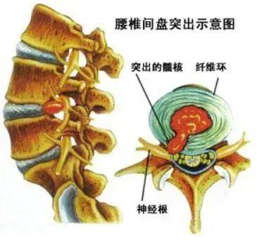 腰间盘突出的原理图解图片