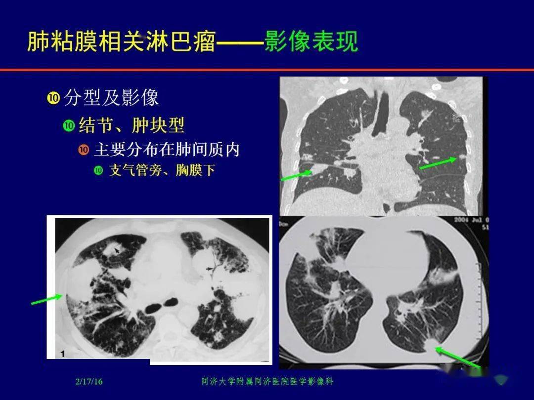 肺粘膜相关淋巴瘤影像诊断