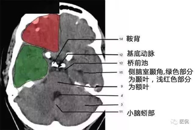 顱腦ct解剖口訣及彩色解剖圖