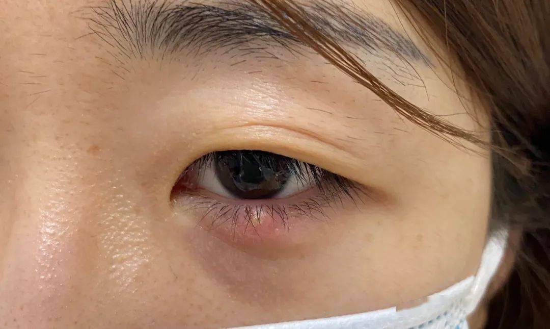麦粒肿,又称睑腺炎(hordeolum),是一种眼睑腺体的急性,痛性,化脓性