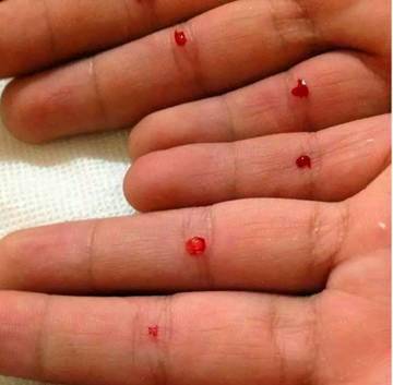 四缝穴,扎一次见效,扎二次痊愈,真是绝了!_手指