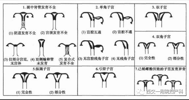 先天性子宫发育异常二