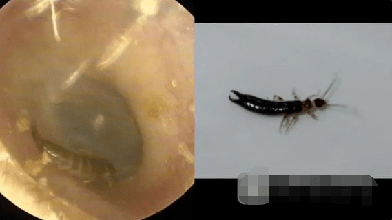 虫子到底怎么跑进耳朵里?